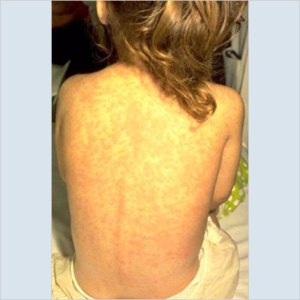 http://www.immunize.org/photos/measles-photos.asp